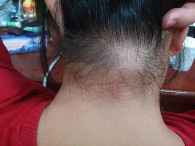 后颈上有像小疙瘩的东西怎么回事 下面附图