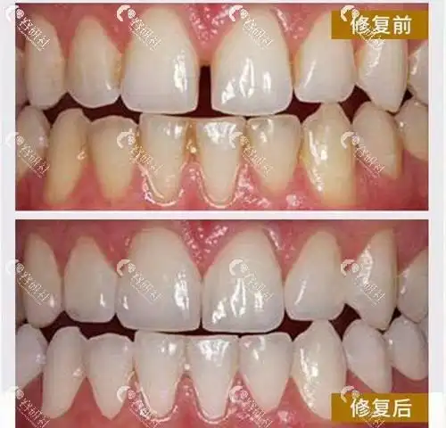 瓷贴面前后对比照合集用案例告诉你瓷贴面可以维持多久