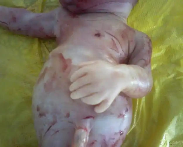 少见的胎儿六指畸形,同时存在骨发育不良!公布引产照片!