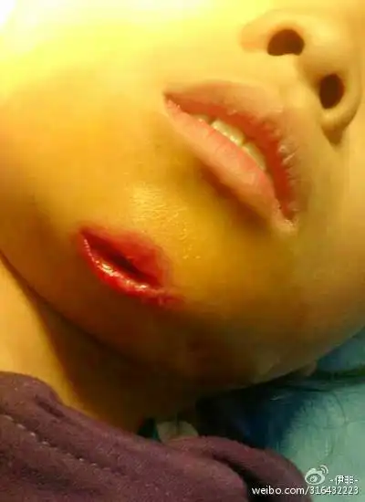 学生受伤的下颚伤口