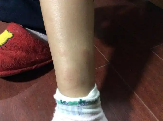 小孩腿上长了好几个红块,有点红肿,摸上去有点硬,有点痛_百度宝宝知道