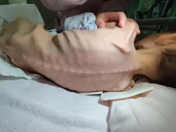 从瘦的皮包骨到自信地笑愉快地跑同济医院小儿外科首创肛肠平衡原则再