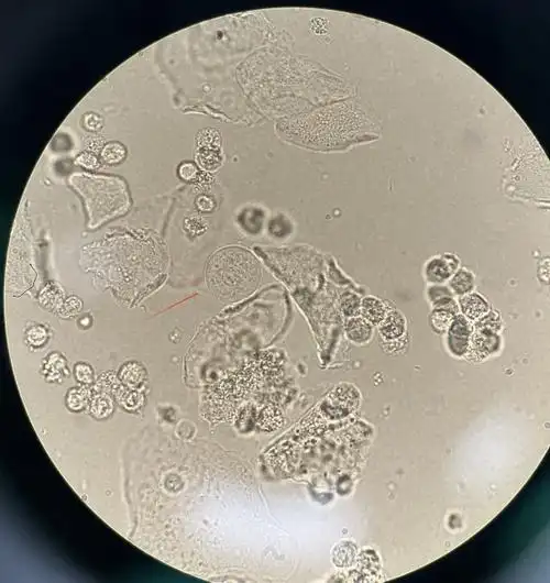 尿液中 10 种上皮细胞镜检形态汇总,图片收集全啦!