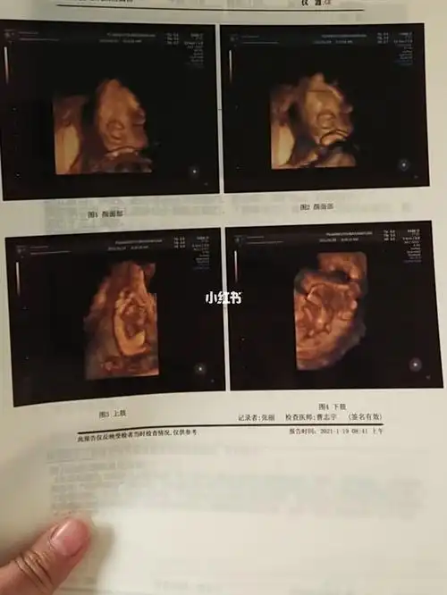 今天四维一次过,有没有会看男宝女宝的,太好奇了!