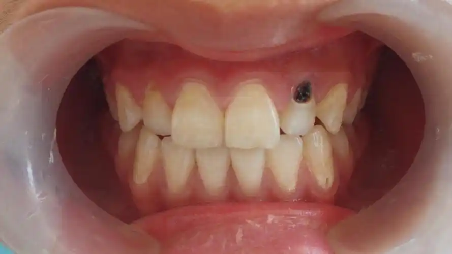 得了龋齿什么情况可以直接补牙什么情况又需要做根管治疗