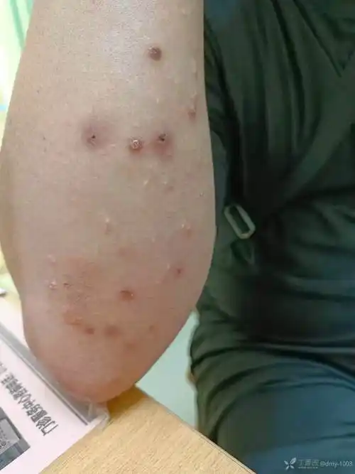 四肢伸侧淡黄色皮疹