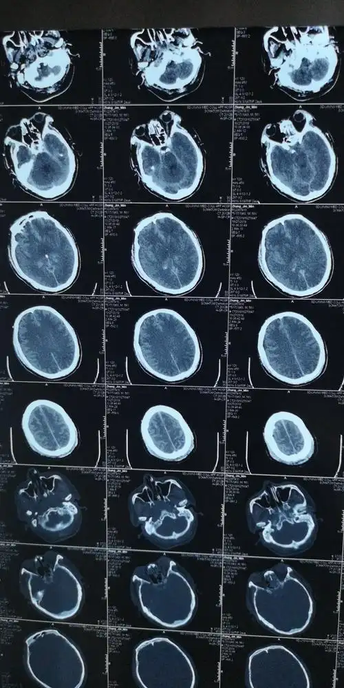 脑疝的头颅ct片是这样的八个并发症告诉你