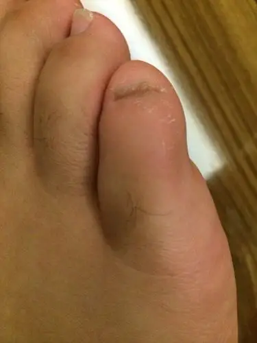 脚小趾头变形成这样怎么办.指甲都快缩到肉里去了