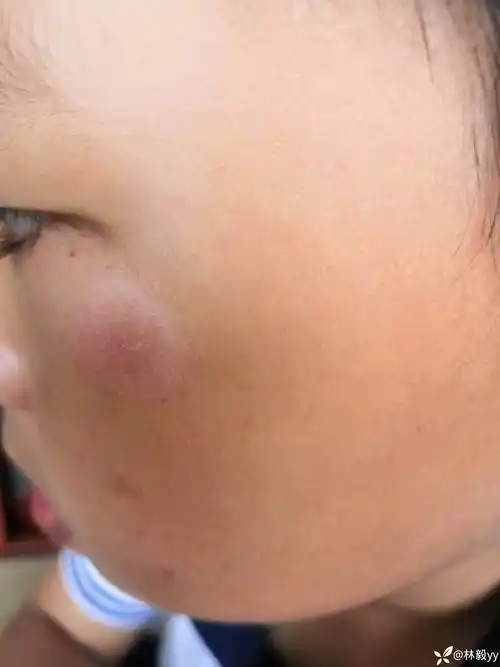 求助儿童面部皮疹
