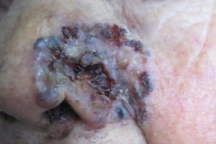 皮肤癌早期症状图片_有来医生