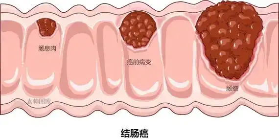 结肠息肉是指发生于结肠黏膜的各种局限性隆起病变.结 - 抖音