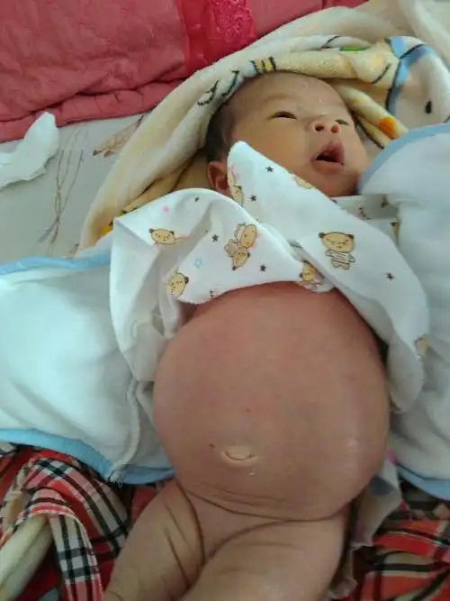 二十天宝宝肚子鼓鼓的怎么回事有没有一样的宝宝求解