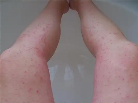 热疹图片9
