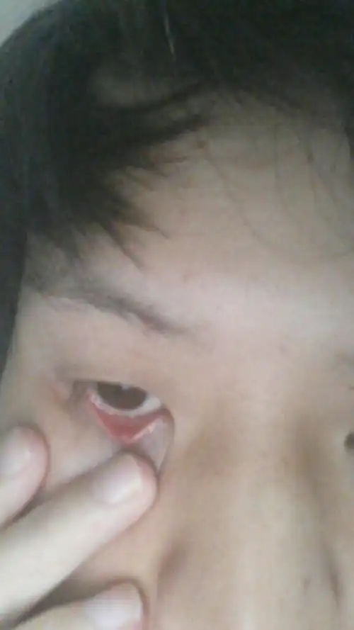 请问我眼睛内皮长的这粒粒东西是什么,怎么治疗?需要动手术吗?