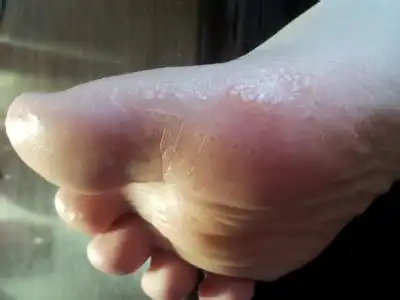 脚底皮肤病图片