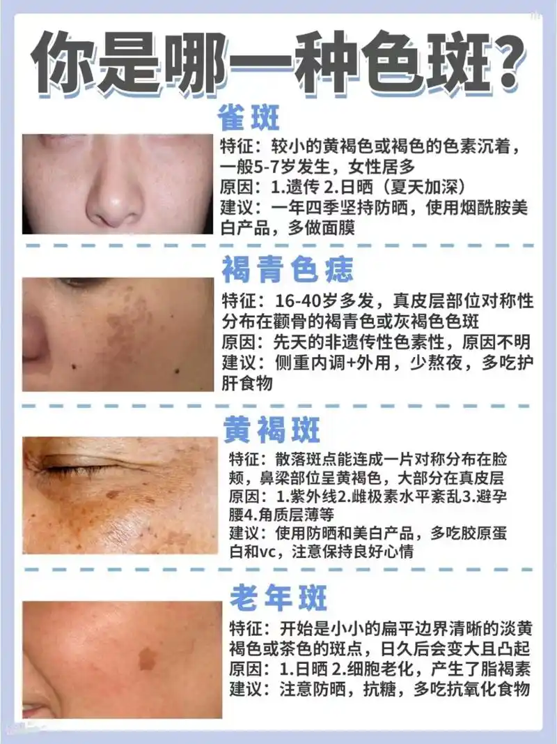 你是哪种呢  雀斑 特征:较小的黄褐或褐色的色素沉着,一般5-7岁发生