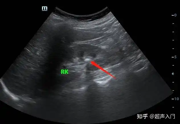 晚上值班一开始我真没看见这个肾结石