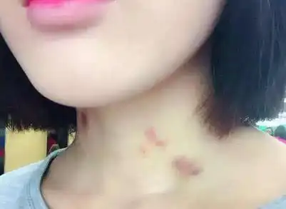 夫妻"亲热"时,别随意"种草莓",会给身体带来2个坏"影响"