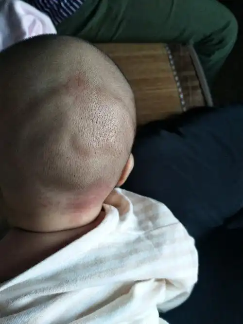 宝宝后脑勺有个半圆的包