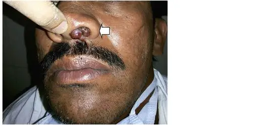 鼻窦炎症状图片 (44)