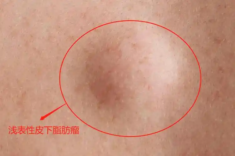 手臂上长了一个瘤怎么办图片