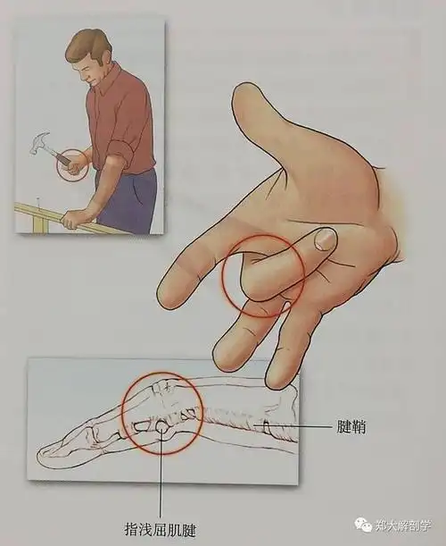 六种引起手部的疼痛综合征