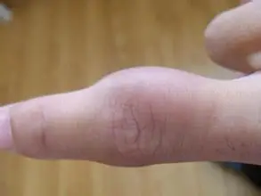 骨质增生的预防要注意保护关节