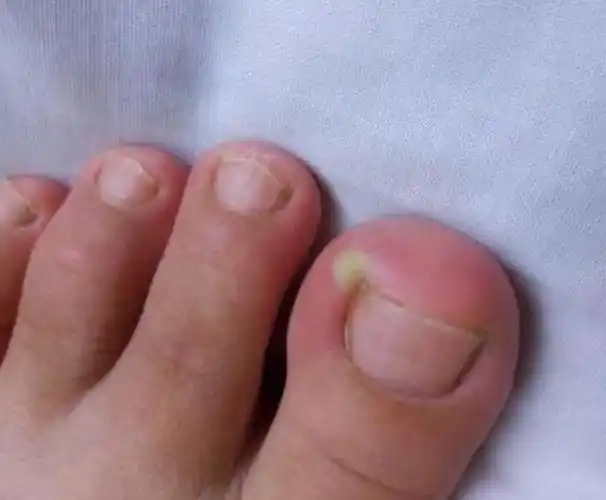 甲沟炎症状较轻者可用抗生素治疗,症状较重时或脓肿形成时,需做手术