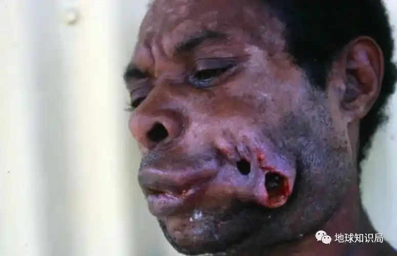 槟榔,谁的毒药?谁的蛋糕?