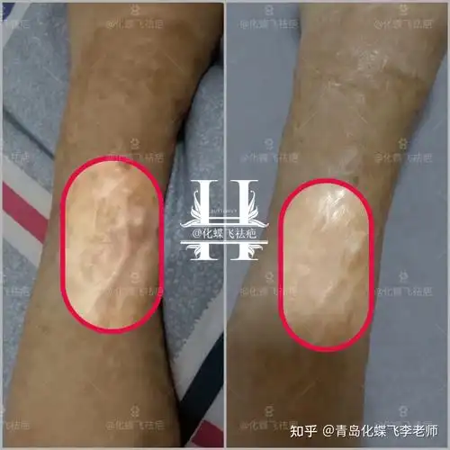 植皮手术疤痕修复对比