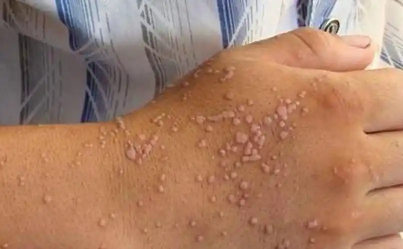 扁平疣图片_扁平疣症状表现图片大全_有来医生