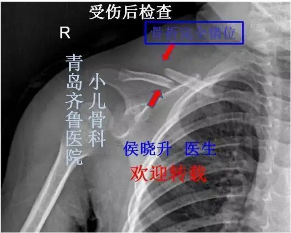 儿童锁骨骨折99不需要手术治疗专家告诉你原因在这里