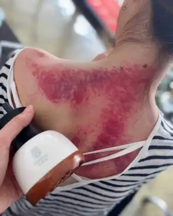 第一次尝试刮痧出这么多痧是不是过分了太吓人了