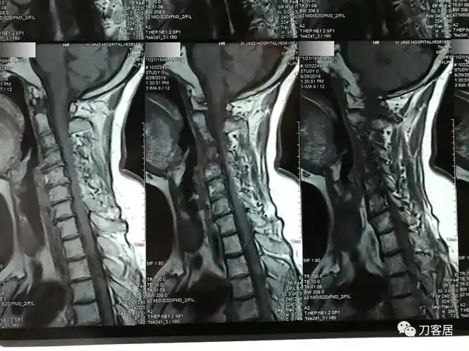 医生及患者通用:如何用手机翻拍x线片,磁共振片子,ct片子进行网络求医