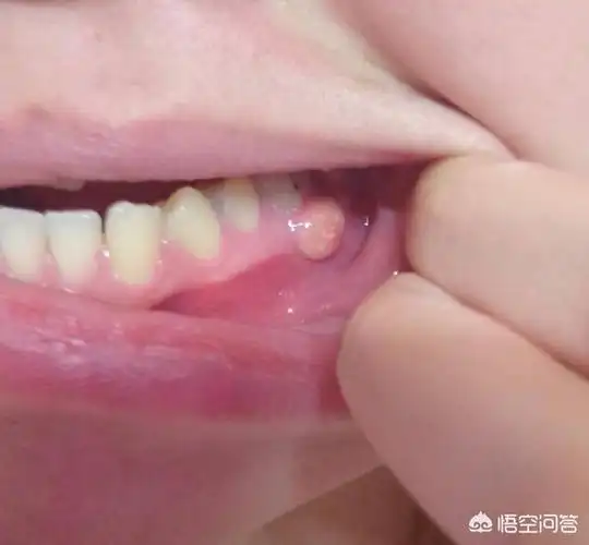 小孩牙龈上长了个包,里面好像有脓,该怎么办?-育儿网