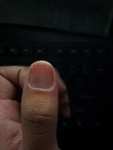 高分求助,指甲上有黑色小条纹是什么原因?如图