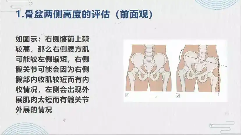 骨盆侧倾自我评估及矫正方法