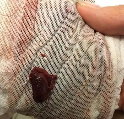 每个月月经快完的时候就会有一个这样的血块,需要去看一下吗?