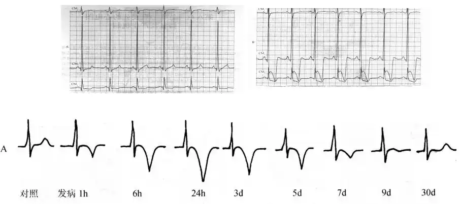 (3)持续性"冠状t波":心尖部肥厚心肌病心肌肥厚局限于心尖部,心电图