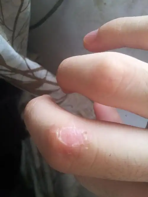 买了药擦,疣的角质脱落了,这种情况算好了吗?