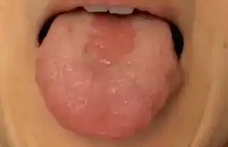 地图舌小儿舌苔会说话