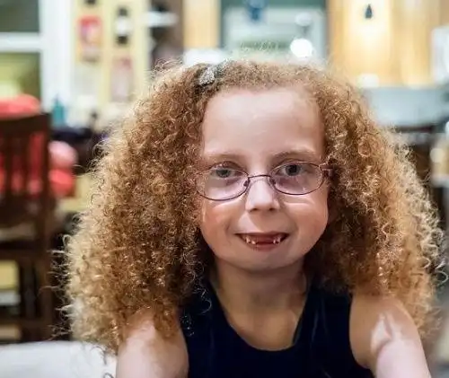 女孩天生无下巴不能说话 全球仅24宗病例