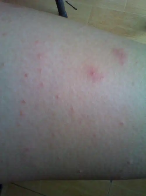 身上出了好多小红痘痘,三天了,热的时候非常痒,一个一个的冒,接着是一