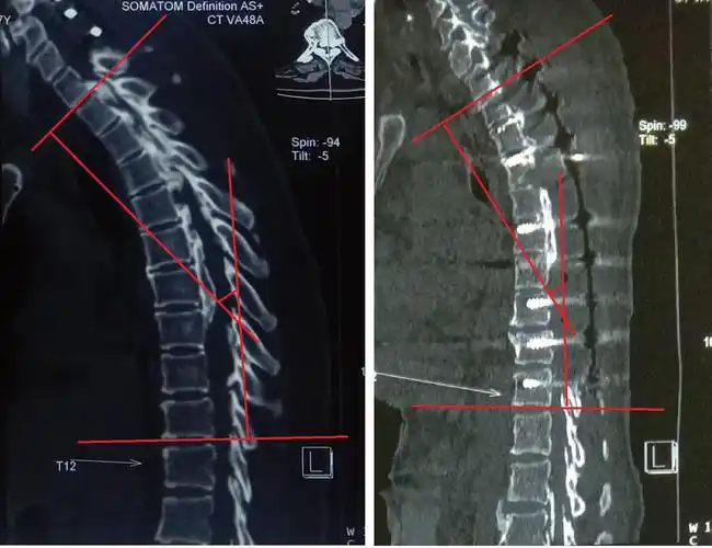 胸椎术后后凸角较术前减小11