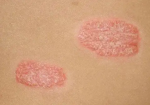 斑块型银屑病症状图片