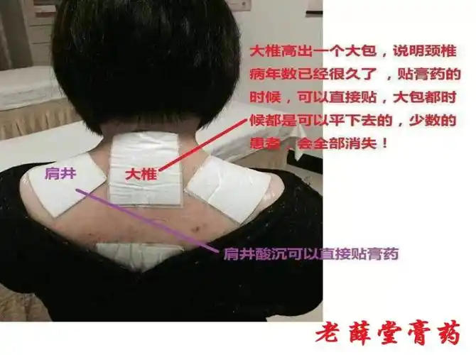 老薛膏药贴法图