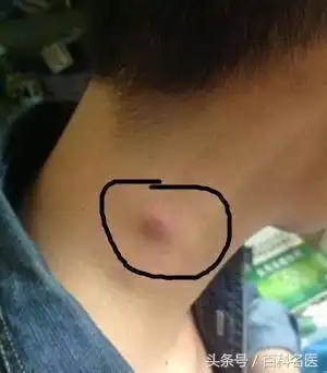 肿大的淋巴结会减少或者消失,只有在颈部淋巴结逐渐长大,疼痛不明显