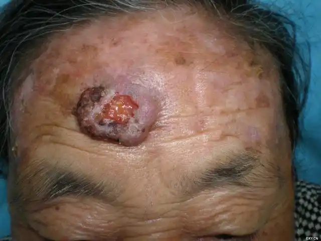 常见皮肤疾病典型图片汇总 - 疫情的典型症状有哪些图片 - 实验室设备