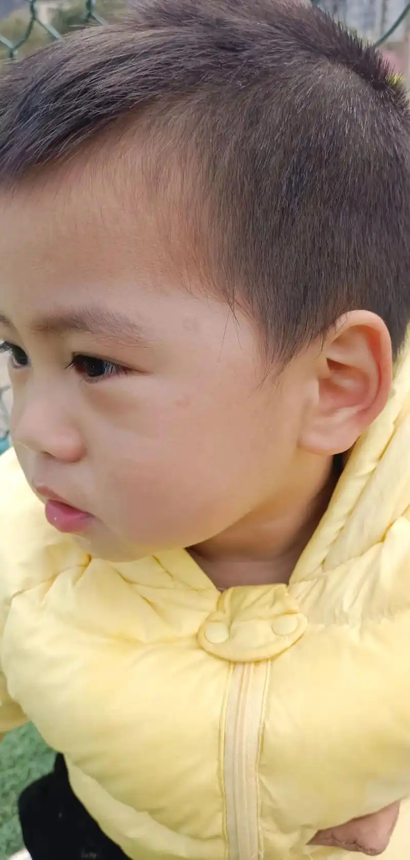 很多人给我说鲜红斑痣不是这样的,但医生说是,当初去安医大一附 - 抖