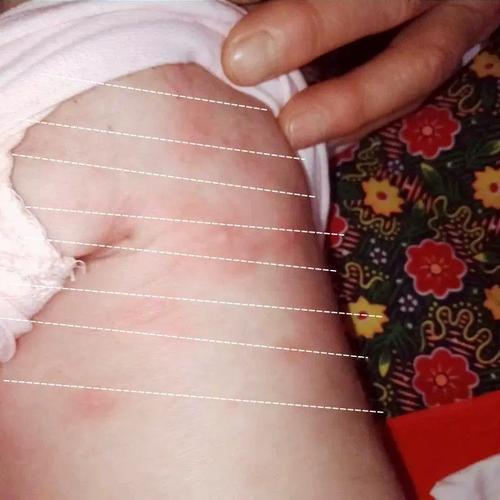 湿疹婴儿专用无激素婴儿宝宝疹子湿疹软膏一岁婴儿湿疹热疹长痘痘